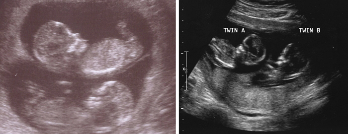 13 недель беременности фото сколько месяцев