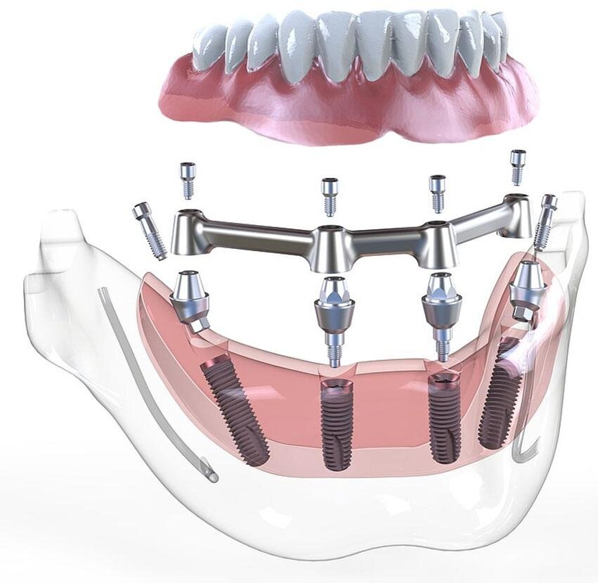 Что такое протезирование и имплантация all on 4